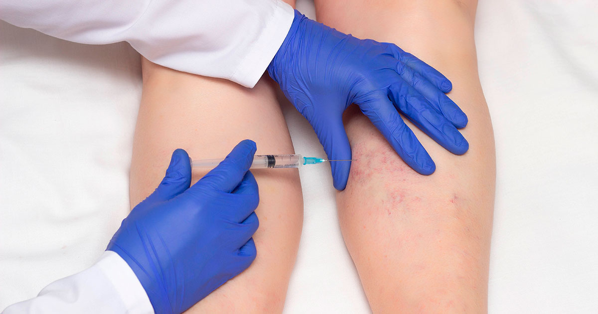 Tratamiento Escleroterapia Química Medicina Estética - LuxuryClínica