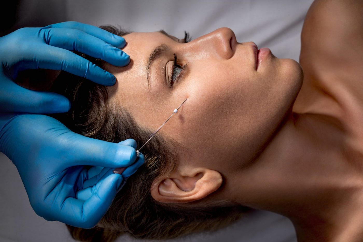 Tratamiento Hilos Tensores Medicina Estética- LuxuryClínica